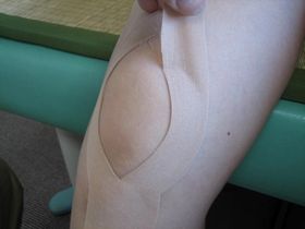 膝痛の治療：キネシオテープ.JPG